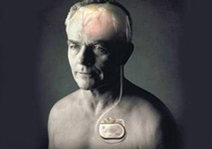 起搏器真的能治好帕金森病嗎？