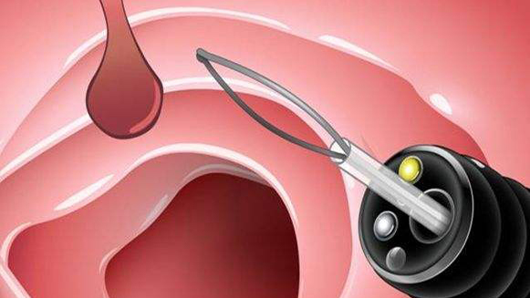 【健康解碼&middot;小貼士】檢查出息肉 需要切除嗎？